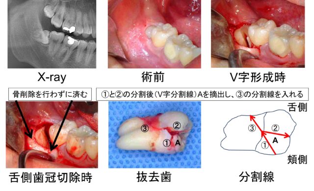 埋伏智歯抜歯の方法と種類について【歯科医療従事者向け】 | 歯と口腔