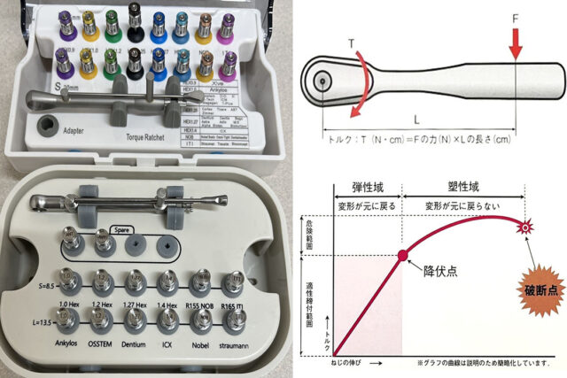 インプラント170種類の補綴時締結トルク値 サムネイル