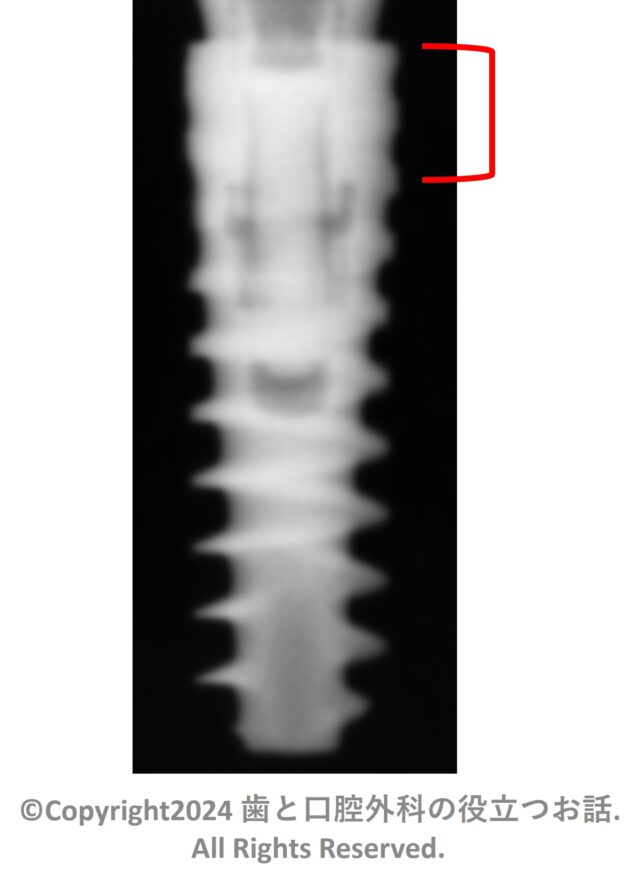 Nobel Biocare N1 system Implant